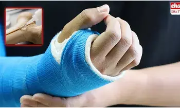 Bone Glue : ఎముకల ఫ్రాక్చర్లను 3 నిమిషాల్లో అతికించే బోన్ గ్లూ Bone Glue : ఎముకల ఫ్రాక్చర్లను 3 నిమిషాల్లో అతికించే బోన్ గ్లూ