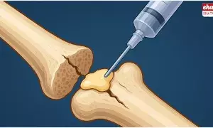 Bone-02 : 2-3 నిమిషాల్లోనే విరిగిన ఎముకలను అతికించే కొత్త ఇంజెక్షన్..! Bone-02 : 2-3 నిమిషాల్లోనే విరిగిన ఎముకలను అతికించే కొత్త ఇంజెక్షన్..!