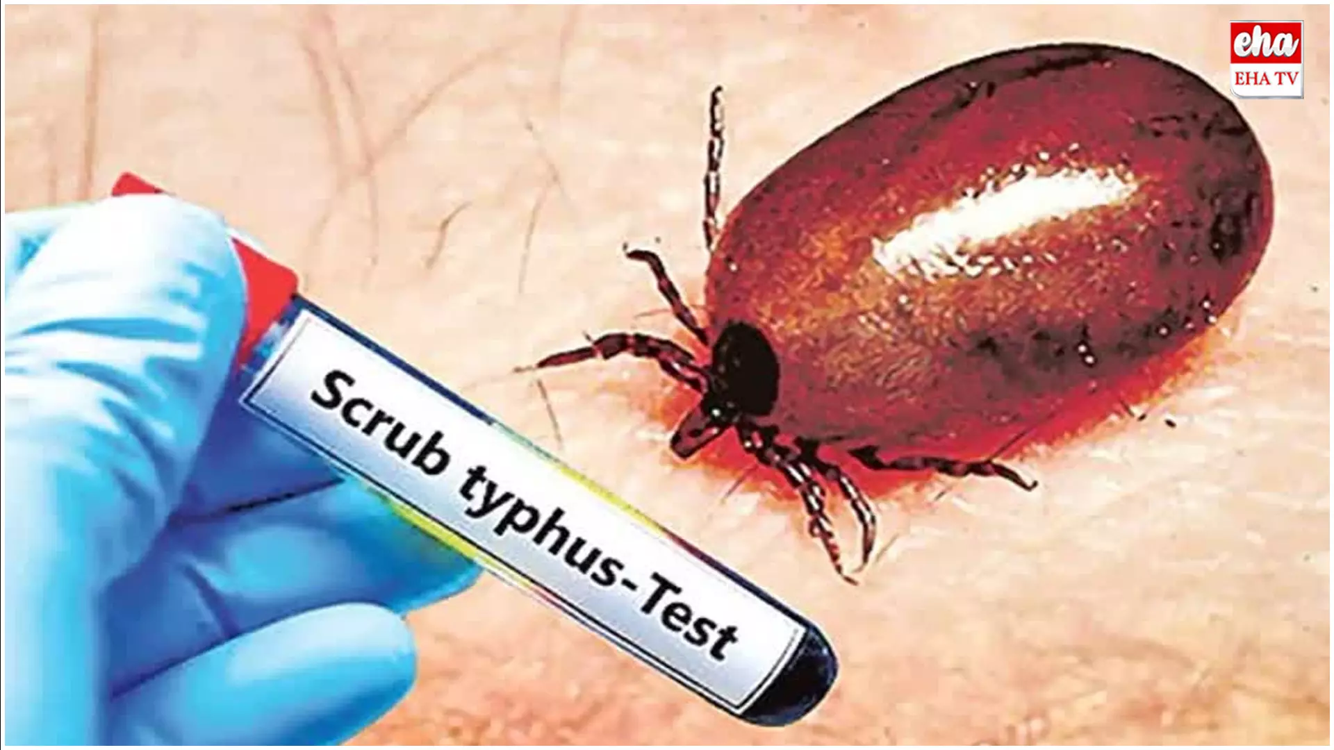 Scrub typhus : ఏపీలో కొత్త పురుగు వ్యాధి కలకలం Scrub typhus : ఏపీలో కొత్త పురుగు వ్యాధి కలకలం