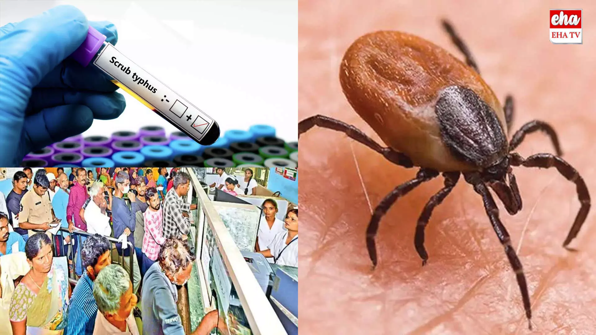 Scrub Typhus : ఏపీని వణికిస్తున్న స్క్రబ్ టైఫస్ Scrub Typhus : ఏపీని వణికిస్తున్న స్క్రబ్ టైఫస్