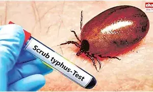 Scrub Typhus :  ఏపీలో స్క్రబ్ టైఫస్ కేసుల భయం..భయం.. 20కి చేరిన మృతులు..!