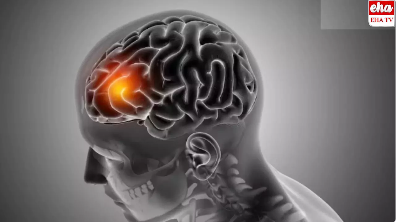Stroke Symptoms: నిద్రలేవగానే ఈ లక్షణాలు కన్పిస్తే స్ట్రోక్ వస్తున్నట్లే..! Stroke Symptoms: నిద్రలేవగానే ఈ లక్షణాలు కన్పిస్తే స్ట్రోక్ వస్తున్నట్లే..!